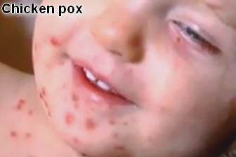 has any adult had the chicken pox shot has any adult had the chicken pox shot